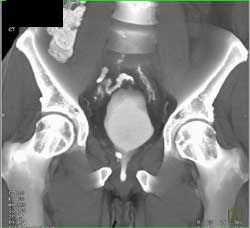 Leak From Bladder S/P Transurethral Resection of the Prostate (TURP) - CTisus CT Scan