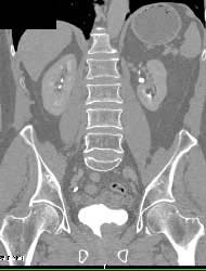 Transurethral Resection of the Prostate (TURP) Defect - CTisus CT Scan