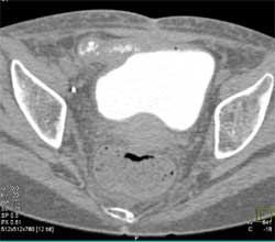 Fistulae From Small Bowel to Bladder - CTisus CT Scan