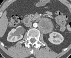 Paraganglioma - CTisus CT Scan