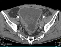 Bladder Cancer - CTisus CT Scan