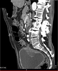 Bladder Cancer - CTisus CT Scan