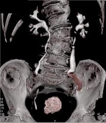 Bladder Cancer - CTisus CT Scan