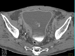 Bladder Cancer - CTisus CT Scan