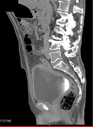 Bladder Cancer - CTisus CT Scan