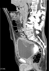 Bladder Cancer - CTisus CT Scan