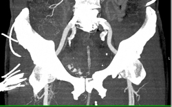 Pelvic Fracture W/o Vascular Injury But With Bladder Injury - CTisus CT Scan