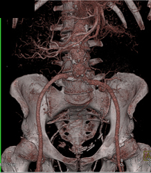 Renal Transplants and Pelvic Mass - CTisus CT Scan