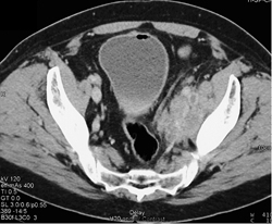 Bladder Cancer With Pelvic Adenopathy - CTisus CT Scan