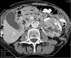 Retroperitoneal Fibrosis - CTisus CT Scan