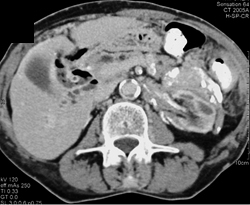 Retroperitoneal Fibrosis - CTisus CT Scan