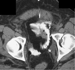 Pelvic Trauma With Bladder Injury and Contrast Extravasation - CTisus CT Scan