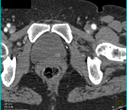 Subtle Bladder Cancers With Early Enhancement - CTisus CT Scan