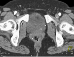 Bladder Cancer - CTisus CT Scan