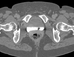 Bladder Cancer - CTisus CT Scan