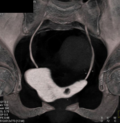 Bladder Cancer - CTisus CT Scan