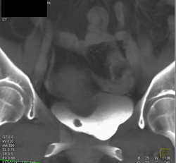 Bladder Cancer - CTisus CT Scan