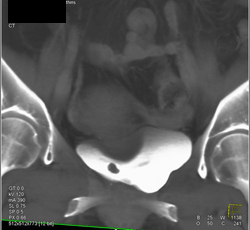 Bladder Cancer - CTisus CT Scan