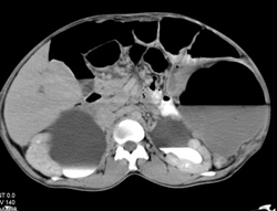 Bilateral Hydronephrosis and Neobladder - CTisus CT Scan