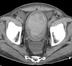 Hematoma in the Bladder - CTisus CT Scan