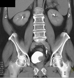 Bladder Cancer - CTisus CT Scan