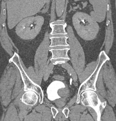 Bladder Cancer - CTisus CT Scan