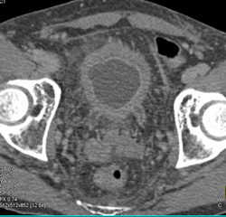 Bladder Cancer - CTisus CT Scan