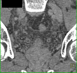 Bladder Cancer - CTisus CT Scan