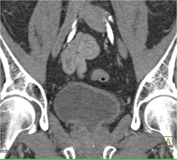 Bladder Cancer - CTisus CT Scan