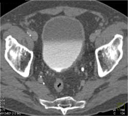 Bladder Cancer - CTisus CT Scan