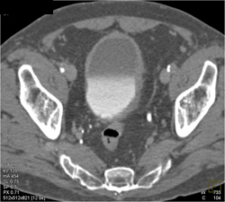 Bladder Cancer - CTisus CT Scan