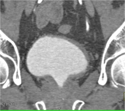 Bladder Cancer - CTisus CT Scan