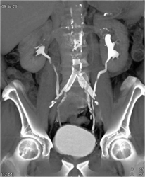 Normal CT Urogram - CTisus CT Scan