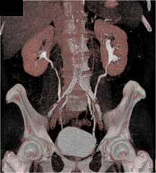 Normal CT Urogram - CTisus CT Scan