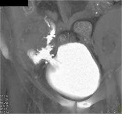 Pancreatic Transplant With CT Cystogram Showing Anastomosis - CTisus CT Scan