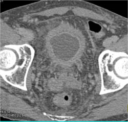 Bladder Cancer With Thickened Left Ureter - CTisus CT Scan