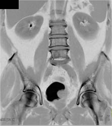 Bladder Cancer - CTisus CT Scan