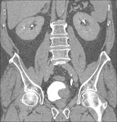 Bladder Cancer - CTisus CT Scan