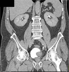 Bladder Cancer - CTisus CT Scan