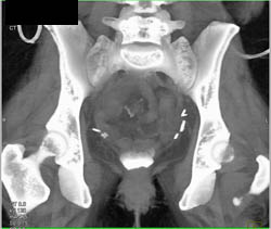 Cystocele - CTisus CT Scan