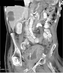 Bladder Cancer - CTisus CT Scan