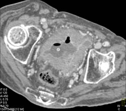 Bladder Cancer - CTisus CT Scan