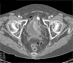 Bladder Cancer - CTisus CT Scan