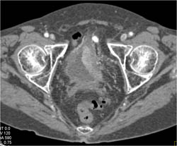 Bladder Cancer - CTisus CT Scan