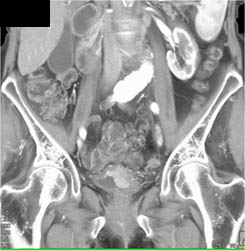 Bladder Cancer - CTisus CT Scan