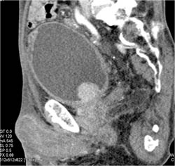 Bladder Cancer - CTisus CT Scan