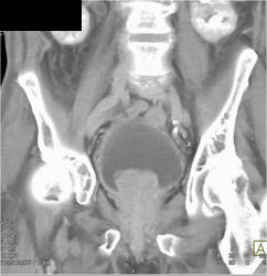 Bladder Cancer - CTisus CT Scan