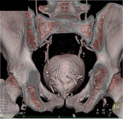 Cystogram S/P Prostate Resection - CTisus CT Scan