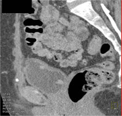 Bladder Cancer - CTisus CT Scan