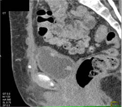 Bladder Cancer - CTisus CT Scan